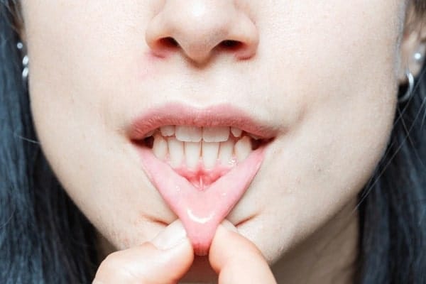 Reverse Gum Recession